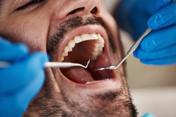 Best Knocked-Out Tooth (Avulsed Tooth) Treatment in Kennedy, CA